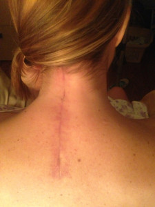 neck scar