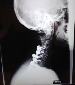 neck xray side July 2013